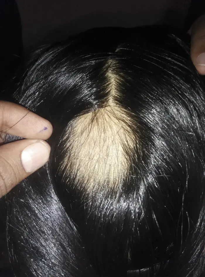 Alopecia Areata case 5 before treatment
